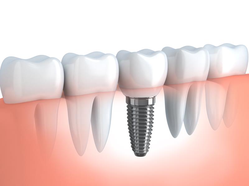 Dental Implants  Elgin, IL