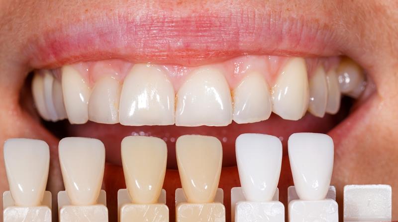 Veneers  Elgin, IL 